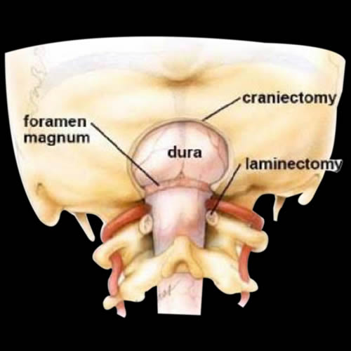 Foramen magnum