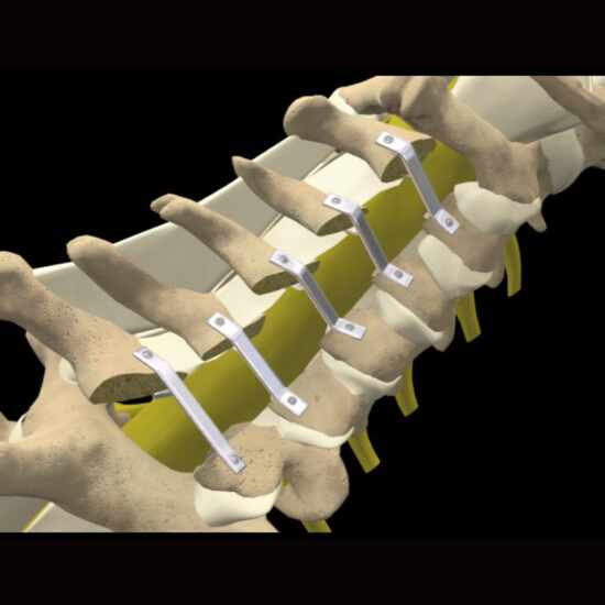 Laminoplasty with strut
